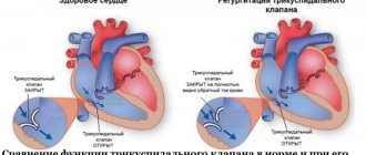 Сравнение функции трикуспидального клапана в норме и при его недостаточности