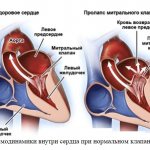Comparison of hemodynamics inside the heart with a normal valve and MVP