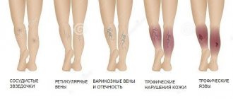 Стадии варикоза или варикозной болезни нижних конечностей