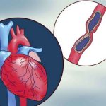 Prinzmetal&#39;s angina (vasospastic)