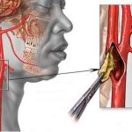 Carotid-artery-stenosis-385x300.jpg