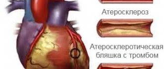 стентирование сердца