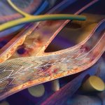 Carotid artery stenting