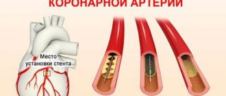 Stenting