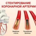 Stenting
