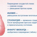 Subendocardial ischemia on the ECG. What it is 