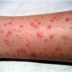 rash due to vasculitis