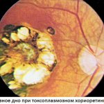 Toxoplasmosis chorioretinitis