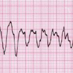 Ventricular flutter on the electrocardiogram