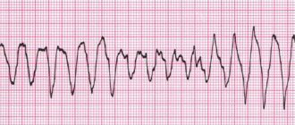 Ventricular flutter on the electrocardiogram