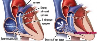 tricuspid-regurgitation