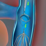 Thrombectomy in St. Petersburg