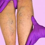 Тромбофлебит