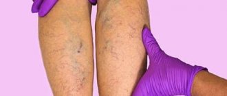 Thrombophlebitis