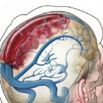Cavernous sinus thrombosis