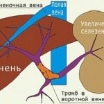 Portal vein thrombosis is not such a rare occurrence.