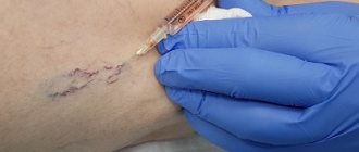 Удаление сосудистых звездочек методом микросклеротерапии
