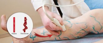 Doppler ultrasound or Doppler ultrasound