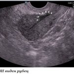 Ultrasound of the heart