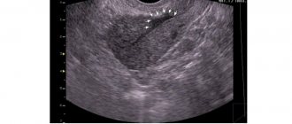 Ultrasound of the heart