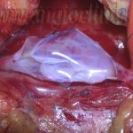 Valvuloplasty - restoration of deep vein valves