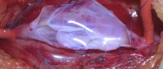 Valvuloplasty - restoration of deep vein valves