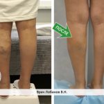 Varicose veins