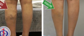 Varicose veins