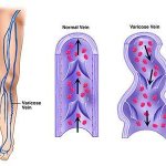 Varicose veins