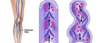 Varicose veins