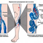 Varicose veins on the legs