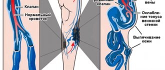 Varicose veins on the legs