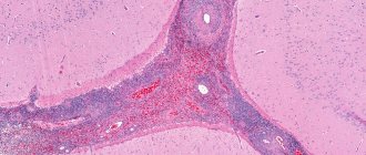 Vasculitis
