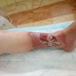 Venous trophic ulcer of the leg