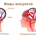 Types of stroke, ischemic and hemorrhagic