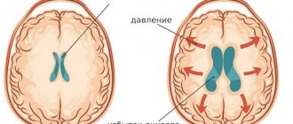 Внутричерепное давление – это сила, с которой мозг давит на стенки черепа
