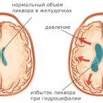 внутричерепное давление при гидроцефалии фото