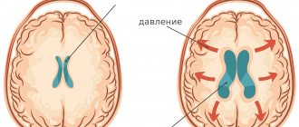 intracranial pressure with hydrocephalus photo