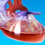 Intracavitary bleeding