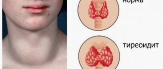 Inflammation of the thyroid gland
