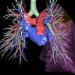Possibilities of 3D reconstruction of CT of the pulmonary artery and its branches