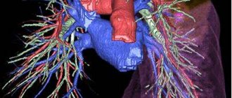 Possibilities of 3D reconstruction of CT of the pulmonary artery and its branches