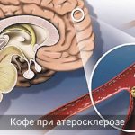 The harm and benefits of coffee for atherosclerosis