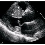 Severe asymmetric hypertrophy of the interventricular septum in HCM