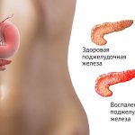 Diseases of the pancreas are accompanied by an increase in diastase in the blood