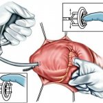 Closed mitral commissurotomy