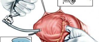 Closed mitral commissurotomy