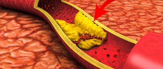 Blocked blood vessels