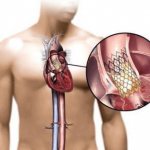 Замена сердечных клапанов