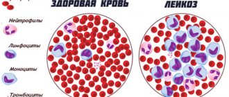 Здоровая кровь и кровь с лейкозом